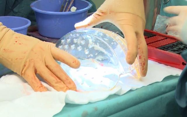 Imagens fortes: mulher recebe prótese de crânio feita em impressora 3D