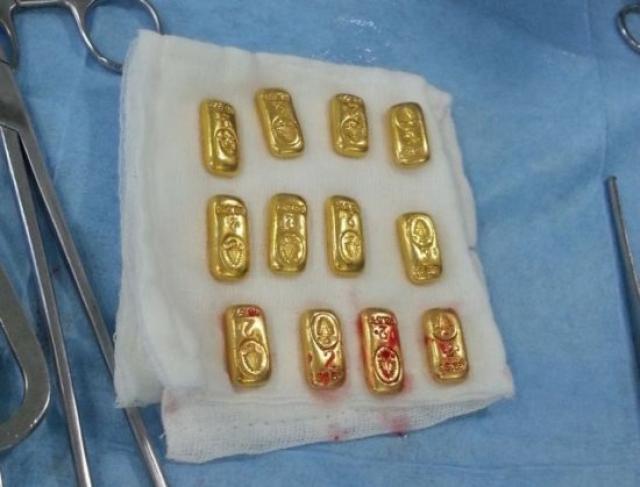 Após reclamar de dor de estômago, médicos fazem cirurgia em empresário indiano e encontram 12 barras