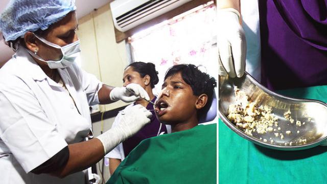 Médicos extraem 232 dentes de menino indiano