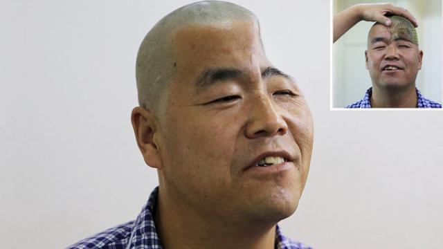 Impressora 3D ajudará a reconstruir crânio de chinês