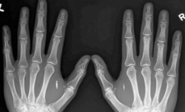 Transumanismo: adeptos implantam chips e imãs nas mãos