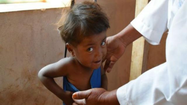 O mistério das crianças de crescimento atrofiado em Madagascar