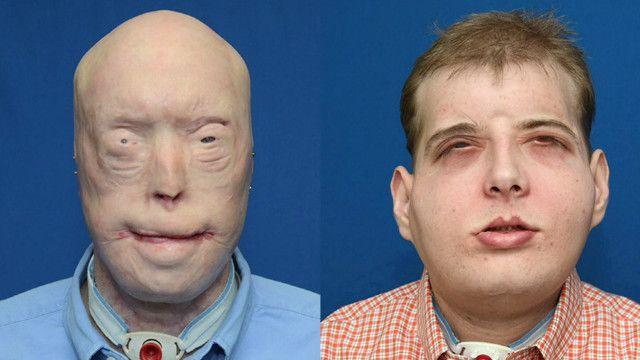 Entenda como foi o mais amplo transplante de rosto já feito