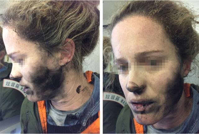 Mulher sofre queimaduras na explosão de fones de ouvido em voo